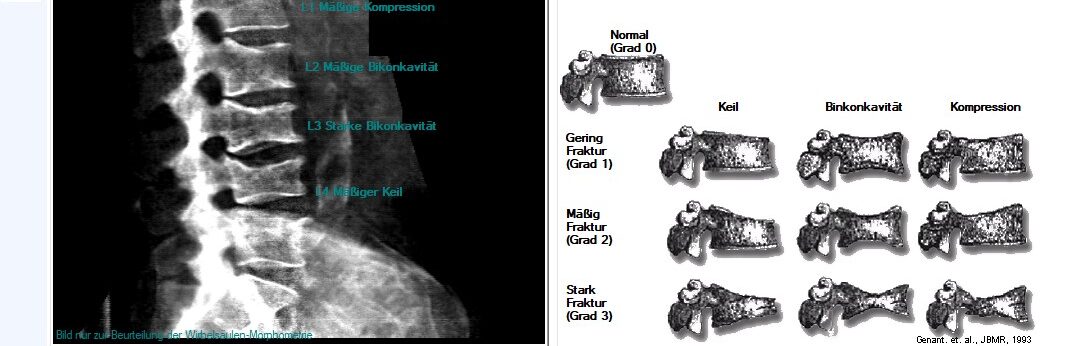 Dual Vertebral Assesment